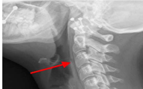 soft tissue neck xray
