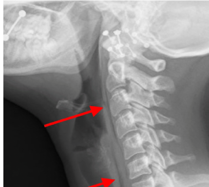 soft tissue neck xray