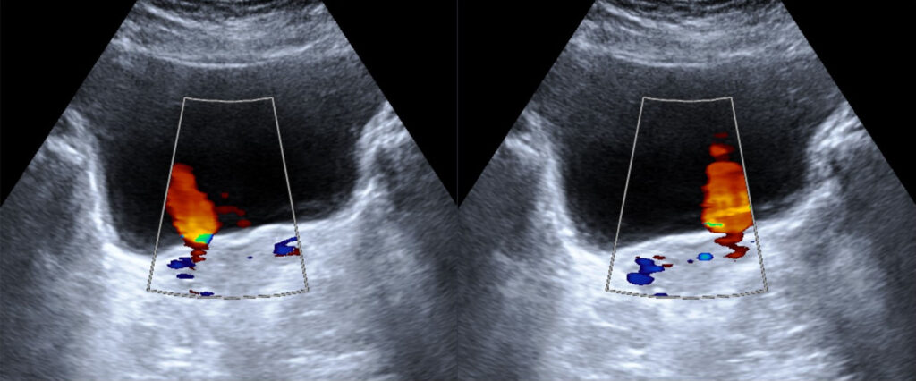 bilateral ureteral jets